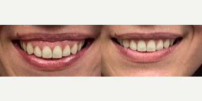 Botox before and after photo