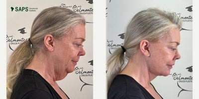 Deep Plane Facelift before and after photo