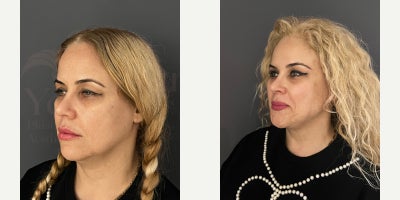 Eyelid Surgery before and after photo