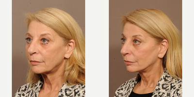 Facelift before and after photo