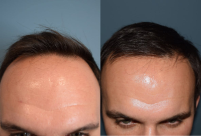 Hair Transplant before and after photo