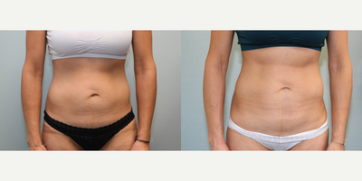 Mini Tummy Tuck before and after photo