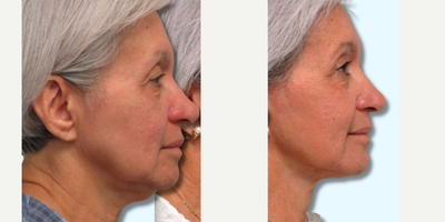 Mini Facelift before and after photo