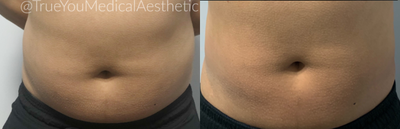 SculpSure before and after photo