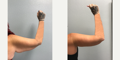 Body Lift before and after photo