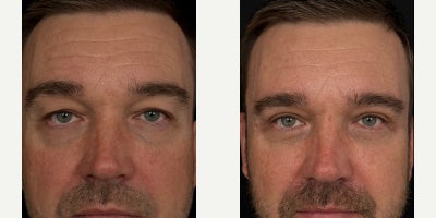 Eyelid Surgery before and after photo