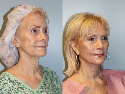 Facelift before and after photo