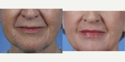 Halo Laser before and after photo