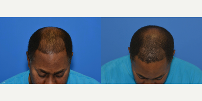 PRP for Hair Loss before and after photo