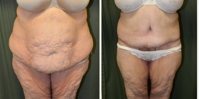 Body Lift before and after photo