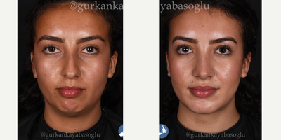 Chin Implant before and after photo