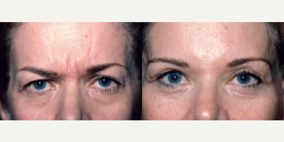 Eyelid Surgery before and after photo