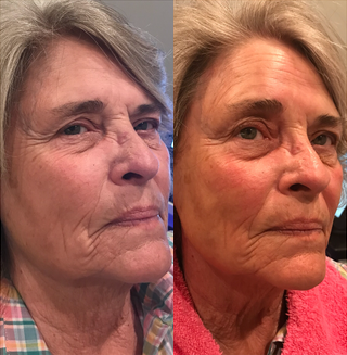 HydraFacial before and after photo