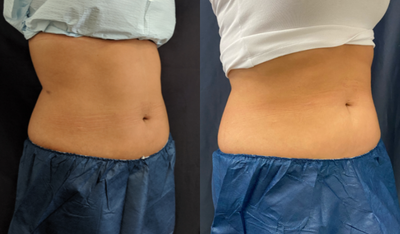 SculpSure before and after photo