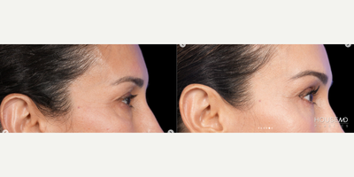 Brow Lift before and after photo