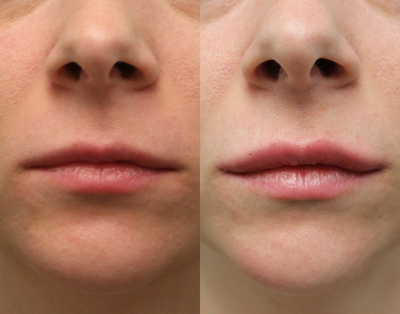 Lip Fillers before and after photo