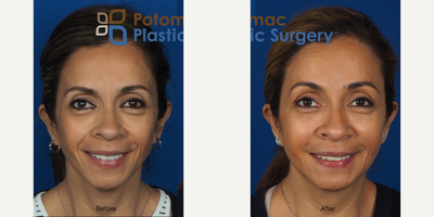 before and after image