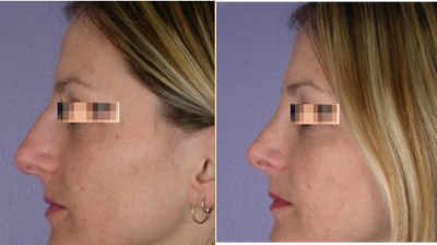 Rhinoplasty before and after photo