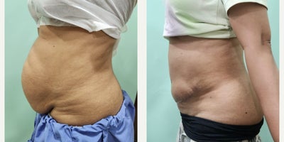 Tummy Tuck before and after photo