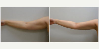Arm Lift before and after photo