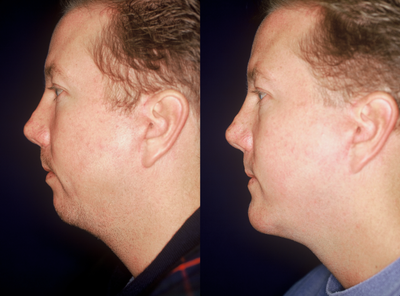 Chin Implant before and after photo