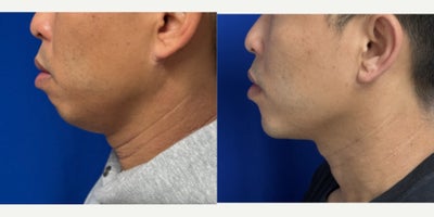 Chin Implant before and after photo