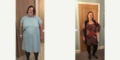 Gastric Sleeve Surgery before and after photo