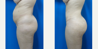 Tummy Tuck before and after photo
