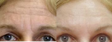 Botox before and after photo