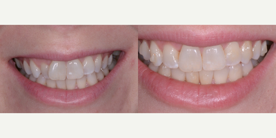 Invisalign before and after photo