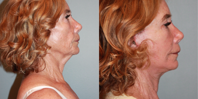 Lower Facelift before and after photo