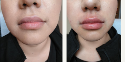 Dermal Fillers before and after photo
