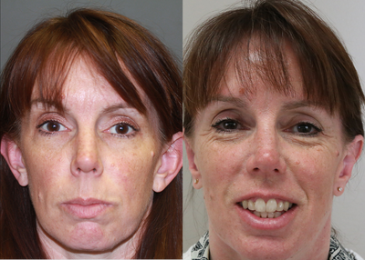 Ear Surgery before and after photo