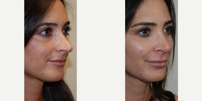 Silikon 1000 before and after photo