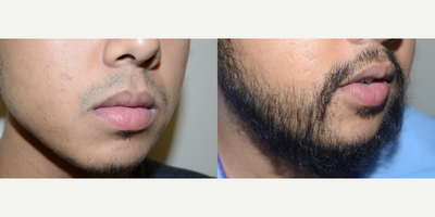 Beard Transplant before and after photo