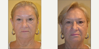 Botox before and after photo