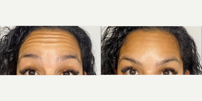 Botox before and after photo
