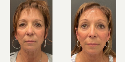 Brow Lift before and after photo