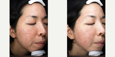 CO2 Laser before and after photo
