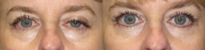 Eyelid Surgery before and after photo