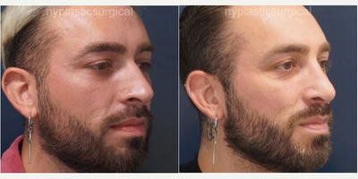 Rhinoplasty before and after photo