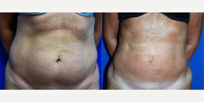 BodyTite before and after photo