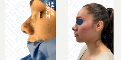 Rhinoplasty before and after photo