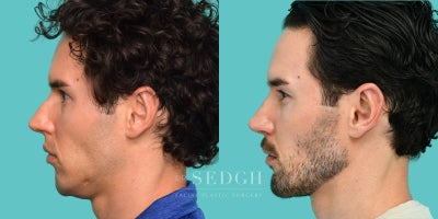 Chin Implant before and after photo