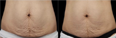 Exilis before and after photo