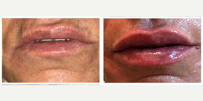 Juvederm before and after photo