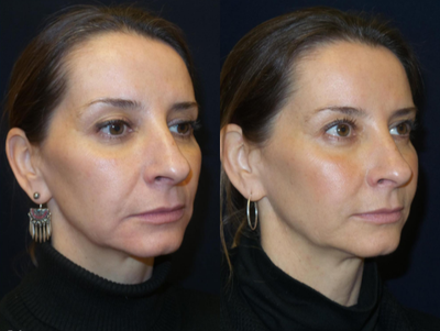 Juvederm before and after photo