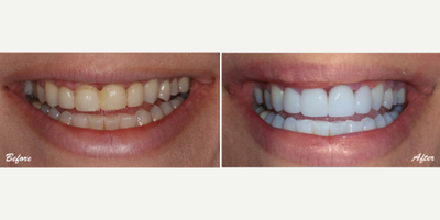 Porcelain Veneers before and after photo