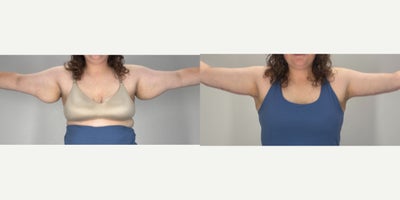 Arm Lift before and after photo