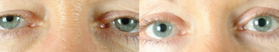 Eyelid Surgery before and after photo